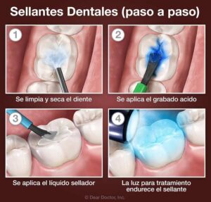 Qué es un tratamiento de sellado y cómo se realiza